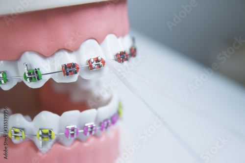 Model denture with metal orthodontics