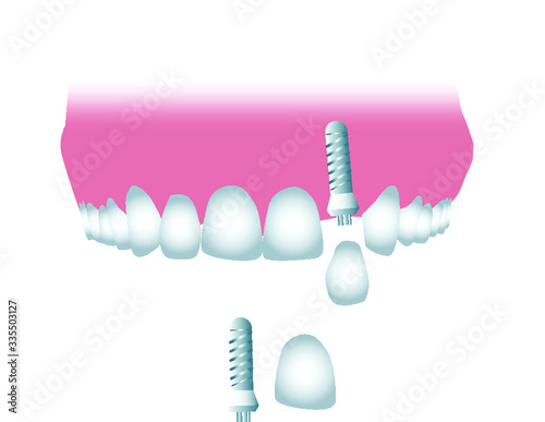 Tooth implant