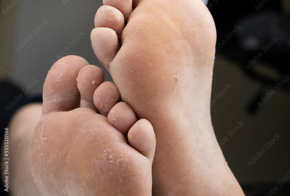 Fungus on the leg close-up isolated on a white background. The concept of dermatology, the treatment of fungal infections and ringworm. Macro photo of human parasites on the foot of a man. Fungus on the leg close-up isolated on a white background. The concept of dermatology, the treatment of fungal infections and ringworm. Macro photo of human parasites on the foot of a man.