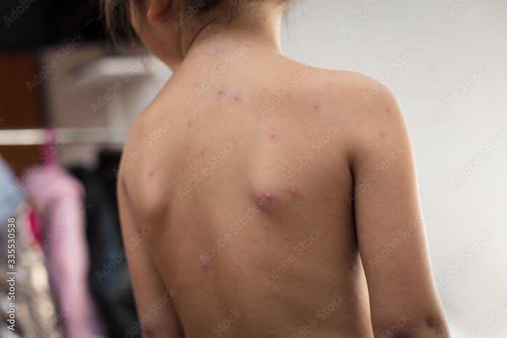 Naklejka premium Her back is exposed to itching.