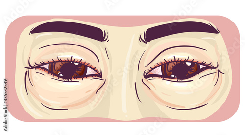 Symptom Swollen Eyes Illustration