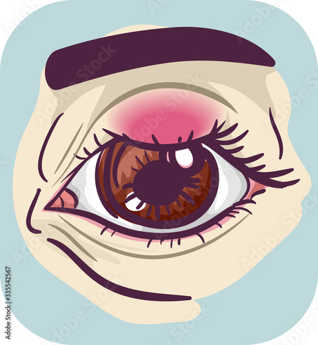 Symptom Eyes Chalazion Illustration