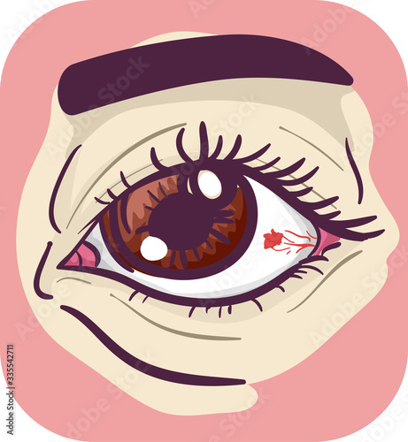 Symptom Red Spot On Eye Ill...