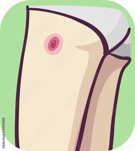 Symptom Boil Illustration