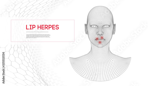 Herpes on lips . Woman herpes on face with treatment cold on the lips.