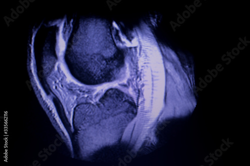 Tableau sur toile MRI knee meniscus tear scan