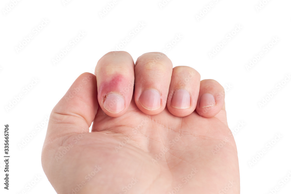 person with finger infection disease. fingernail pain. isolated on white background. copy space person with finger infection disease. fingernail pain. isolated on white background. copy space