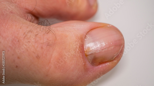Nail infections caused by fungi such as: onychomycosis caused by dermatophytes and yeasts and for the concomitant antibacterial activity