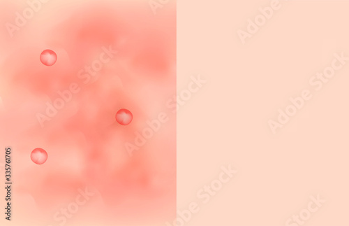 Texture, inflamed pimples and acne. Before After acne cysts. Skin background. Infographics. Vector illustration on isolated background.