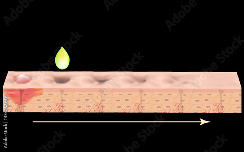 Atrophic scars. Acne scar. The anatomical structure of the skin with acne. Vector illustration.