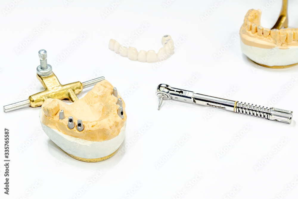 the process of manufacturing ceramic teeth on implants. dental implants