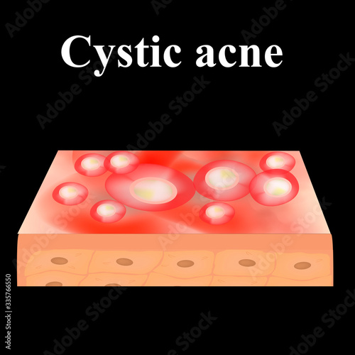 Cyst acne. Acne on the skin of a cyst. Dermatological and cosmetic diseases on the skin of the face. Infographics. Vector illustration on isolated background.