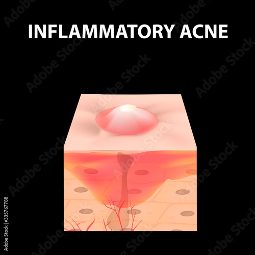 Cyst acne. furuncle Acne on the skin cysts and pimples. Dermatological and cosmetic inflammatory diseases on the skin of the face. Infographics. Vector illustration on isolated background.