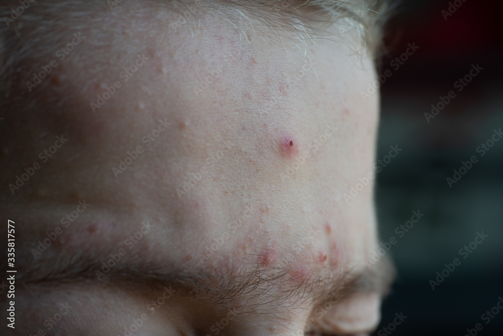 Fototapeta premium teenage boy with acné spots on forehead close up.