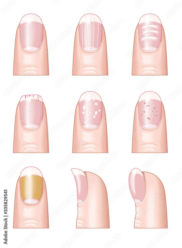 Most common nail disorders and diseases, medically illustration