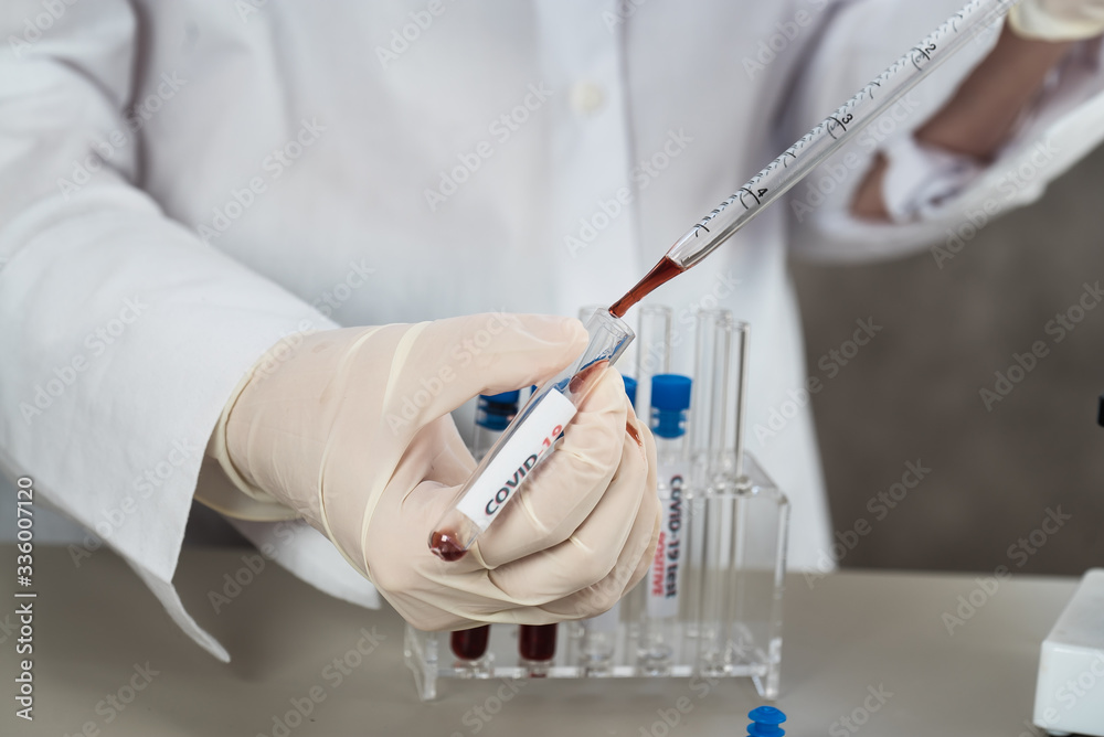 Positive COVID-19, SARS-COv2 test and laboratory sample of blood testing for diagnosis new Coronavirus infection.. Positive COVID-19, SARS-COv2 test and laboratory sample of blood testing for diagnosis new Coronavirus infection..