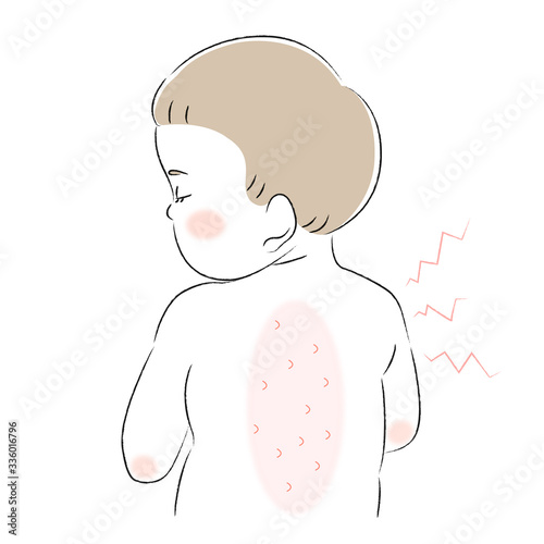 背中　肌　悩み　痒み　子ども　幼児
