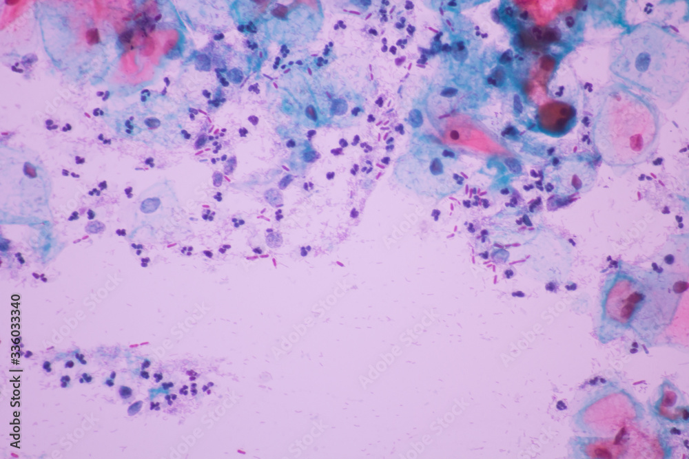 View in microscopic of Candidiasis, fungus infection (Yeast and Pseudohyphae form) in pap smear slide cytology and diagnostic by pathologist.Gynecology report and diagnosis.Medical concept.