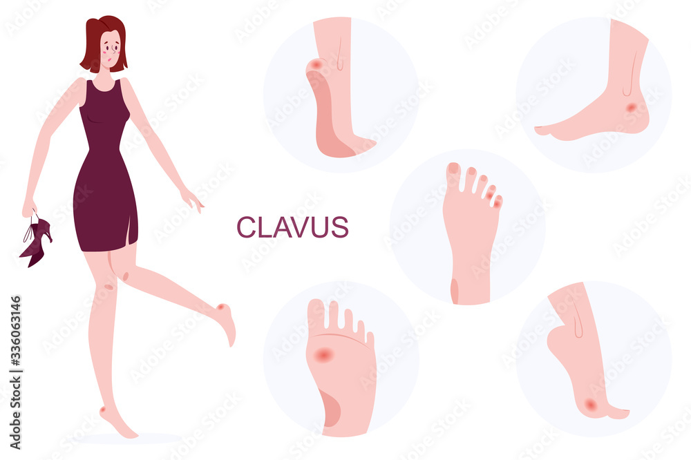Concept of foot callus. Pain markers on foot. Concept of foot callus. Pain markers on foot.