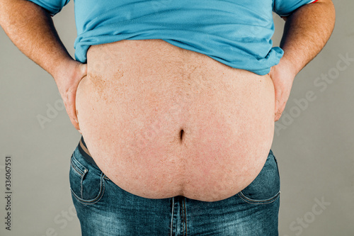 Overweight of a person's body with hands touching the abdomen. The concept of obesity