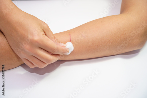 Close up old Men's arms hand, upper limb or arm to the wounded waiting and blood and lesion, slit for nurse treatment on clean the wound dressing a bloody.