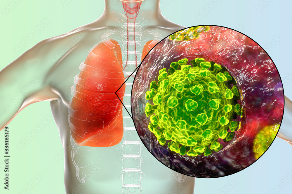 SARS-CoV-2 viruses in alveoli of human lungs causing COVID-19. Novel ...