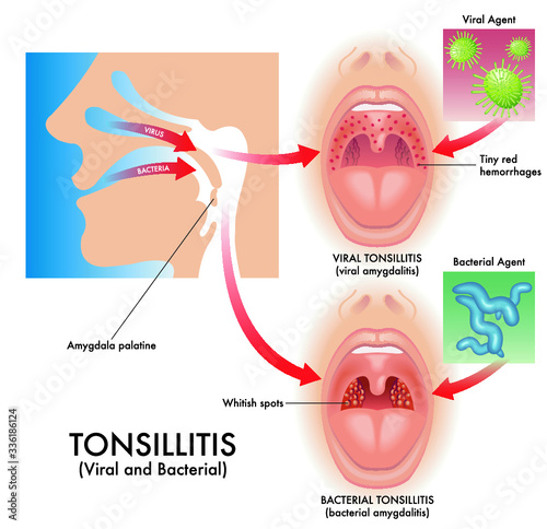 Medical illustration of the symptoms of viral and bacterial tonsillitis, also called viral amygdalitis and bacterial amygdalitis, with the pathogens that cause the infection.