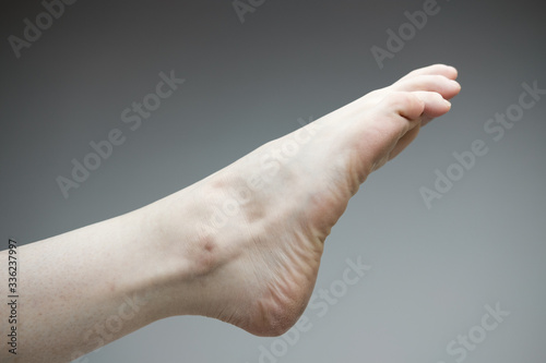 Close up of a woman's foot with pale skin and bruising pointing toward the top right corner of the frame