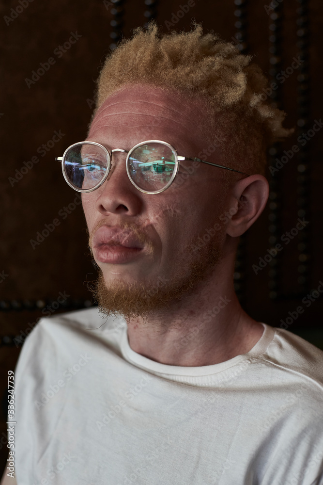 Albino man with round glasses looking sideways Albino man with round glasses looking sideways