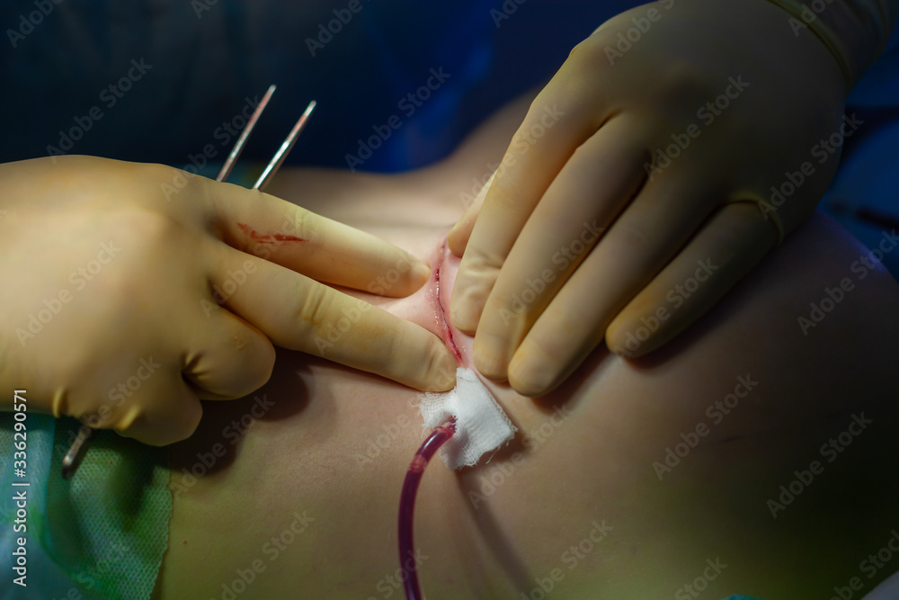 Hospital. Surgeon operates in the operating room. Close up of the surgeon's hands examining the suture on the patient's breast after plastic surgery