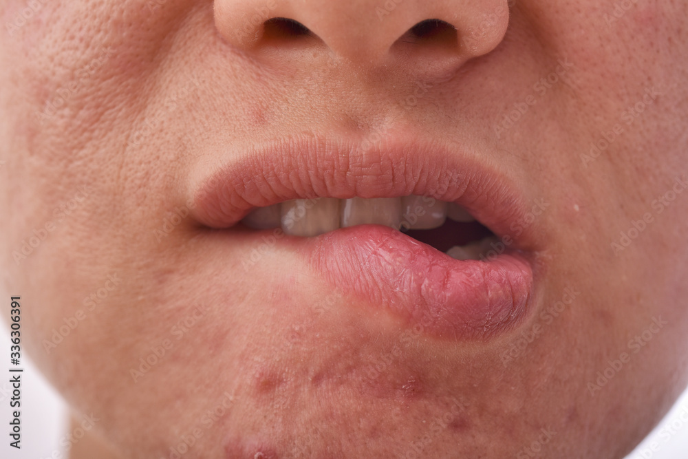 Skin disease problem , Dry and chapped lip from lip biting, Acne scar and pimples with large pore, Aging face and wrinkles, Woman worry about facial problems. Skin disease problem , Dry and chapped lip from lip biting, Acne scar and pimples with large pore, Aging face and wrinkles, Woman worry about facial problems.