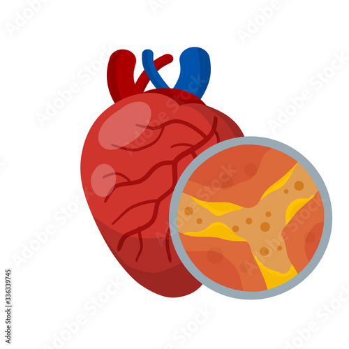 Cholesterol in vein and arteries. Heart and organ disease. Blockage and obstruction of canal. Magnified view under microscope. Health problem. Flat medical education