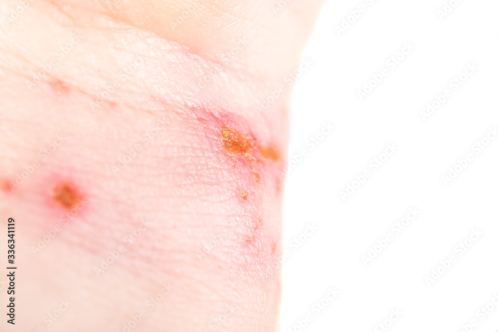 chemical burn on the wrist skin with hydroxide sodium acid, by striping paint from wood furniture. Household accident, because of gloves to sharp