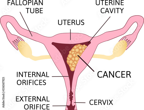 Uterine Cancer Vector Poster or Chart with Cancerous Tumor Cells on Endometrium Tissue of Uterus.