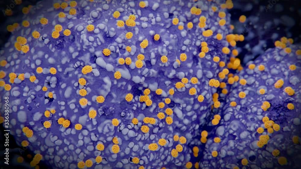 Coronavirus budding out of infected pneumocytes type II in a human lung. After the infection of human cells, coronaviruses multiplicate in the cells and bud out afterwards to infect other cells.