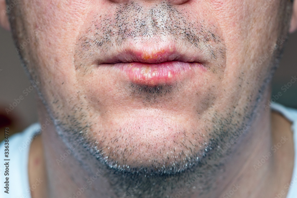 Fototapeta premium Herpes virus infection in a man on the lips