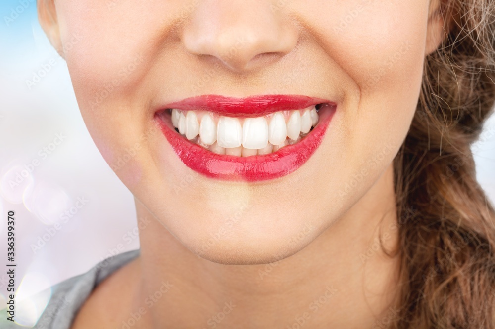 Veneers. Veneers.