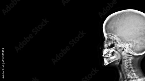 Film X-ray skull radiograph show adenoid hypertrophy. Enlarged adenoid cause airway obstruction and obstructive sleep apnea(OSA) in children. Medical imaging care concept photo