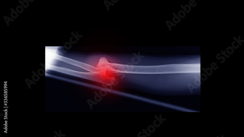 Film X-ray elbow radiograph show elbow dislocation. The patient has joint dislocation from sport injury. Highlight on luxation site and painful area. Medical imaging and diagnosis technology concept