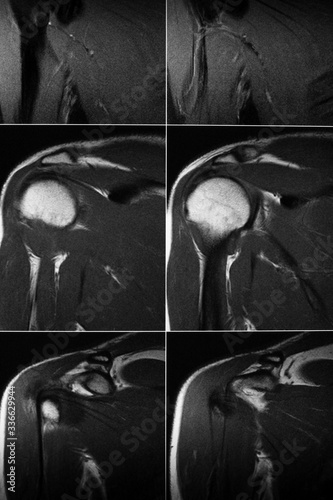 MRI scan of the shoulder joint