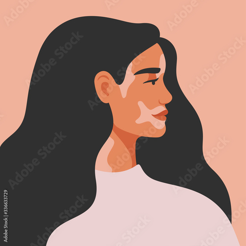Portrait of an young woman with vitiligo in profile. Avatar of young girl with pigmentation on the skin. Vector illustration
