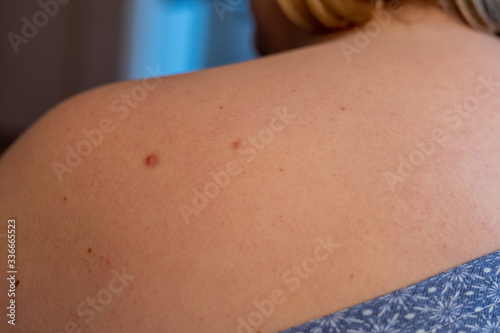 Woman with birthmarks on her skin