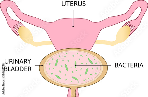 Uterine polyps. Human realistic uterus. Anatomy illustration.