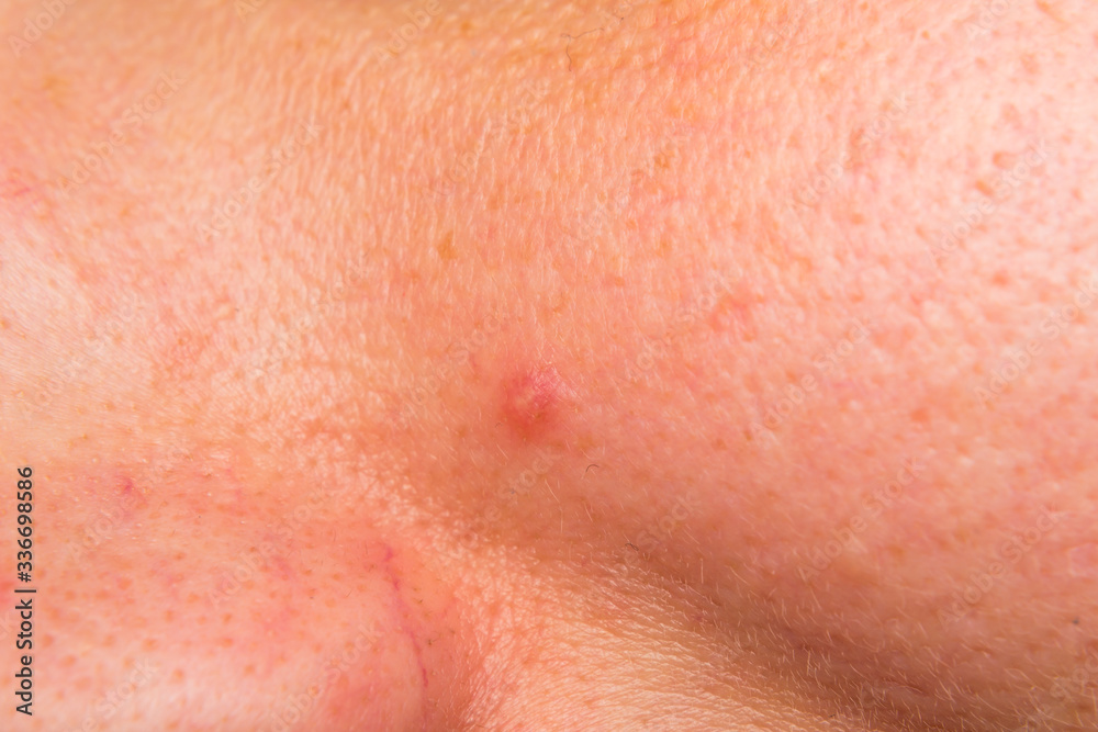 close-up photo of a women face with acne close-up photo of a women face with acne
