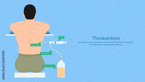 VATS lung cancer treatment sub pus tap cell open tube COPD RATS Wedge treat tumor lobar blebs chest video robot space drain fluid remove tissue biopsy nodule cavity pleura trauma injury surgery