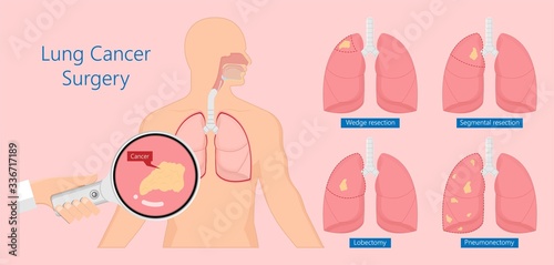 VATS lung cancer treatment sub pus tap cell open tube COPD RATS Wedge treat tumor lobar blebs chest video robot space drain fluid remove tissue biopsy nodule cavity pleura trauma injury surgery