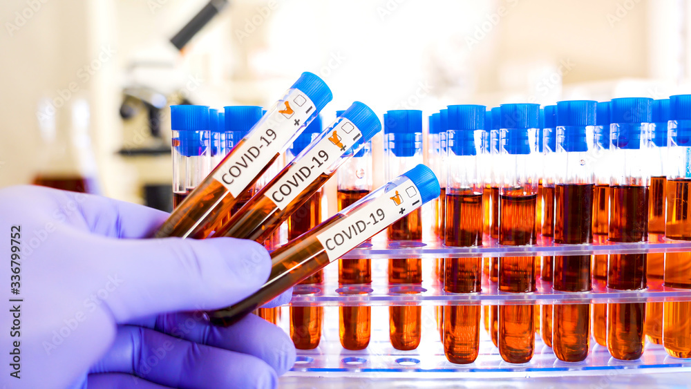 Three positive test of the Covid-19 test samples of coronavirus Three positive test of the Covid-19 test samples of coronavirus