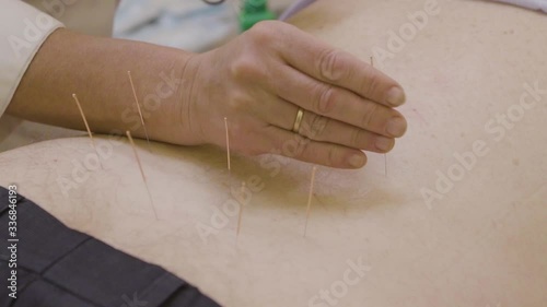 The doctor sticks needles into the girl's body on the acupuncture