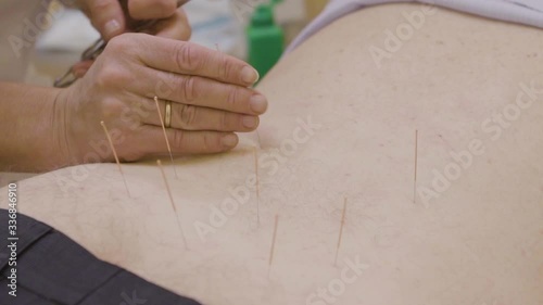 The doctor sticks needles into the girl's body on the acupuncture