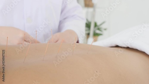 Hands of therapist doing acupuncture at patient back ,Chinese alternative medicine concept.